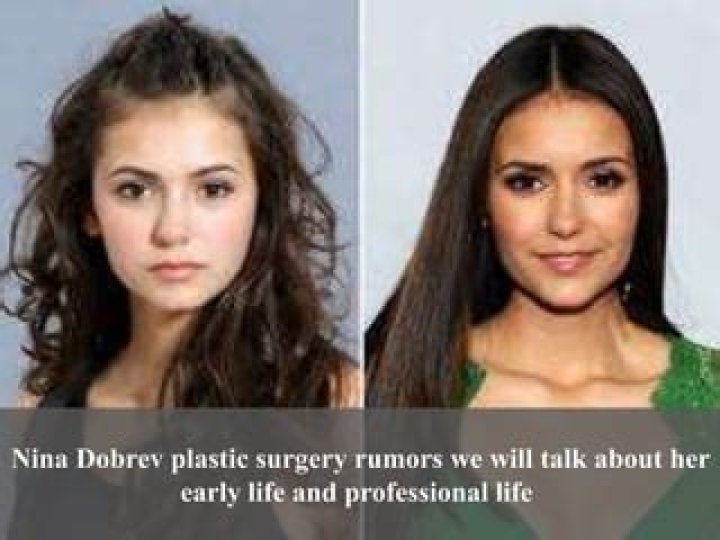 Nina Dobrev and Plastic Surgery: What You Need to Know